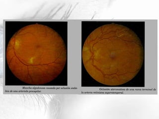 Retina Oftalmología.