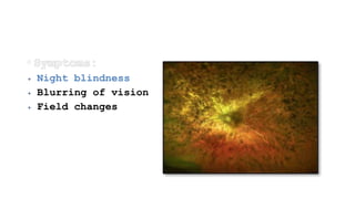  Night blindness
 Blurring of vision
 Field changes
 