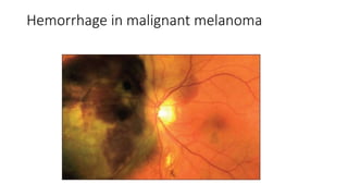 Hemorrhage in malignant melanoma
 