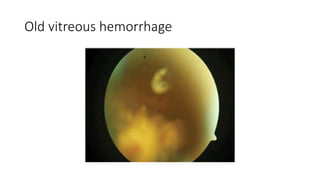 Old vitreous hemorrhage
 