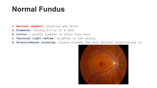 Normal Fundus
1. Retinal vessels: arteries and veins
a. Diameter: Artery 2/3 or 3/ 4 vein
b. Colour : artery lighter in color than vein
c. Vascular light reflex: brighter on the artery
d. Arteriovenous crossing: artery crosses the vein without constricting it.
 