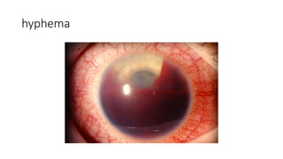hyphema
 