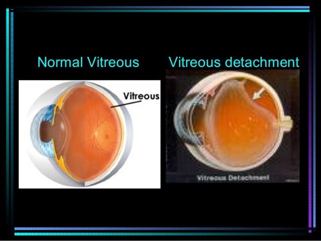 retina vitreous associates inc retina vitreous associates inc