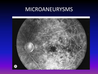 MICROANEURYSMS

 