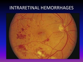 INTRARETINAL HEMORRHAGES

 