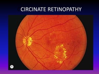 CCIRCINATE RETINOPATHY

 