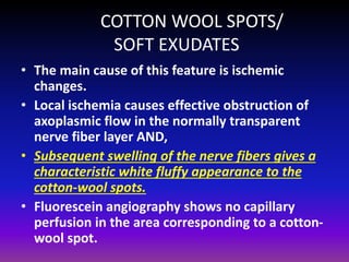COTTON WOOL SPOTS/
SOFT EXUDATES
• The main cause of this feature is ischemic
changes.
• Local ischemia causes effective obstruction of
axoplasmic flow in the normally transparent
nerve fiber layer AND,
• Subsequent swelling of the nerve fibers gives a
characteristic white fluffy appearance to the
cotton-wool spots.
• Fluorescein angiography shows no capillary
perfusion in the area corresponding to a cottonwool spot.

 