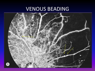 VENOUS BEADING

 