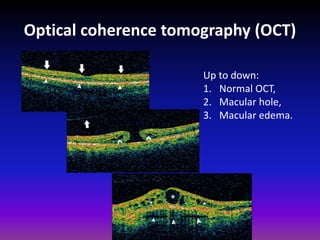 Optical coherence tomography (OCT)
Up to down:
1. Normal OCT,
2. Macular hole,
3. Macular edema.

 