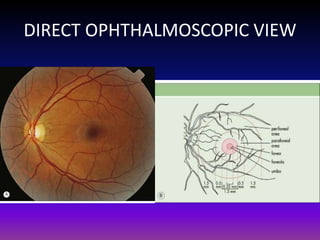 DIRECT OPHTHALMOSCOPIC VIEW

 