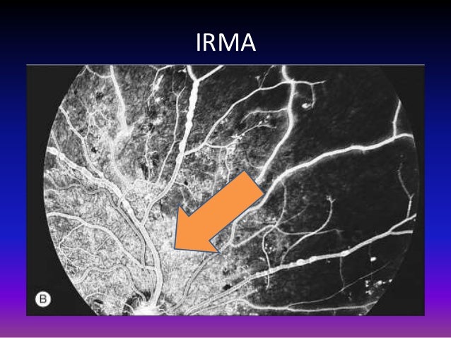 Diabetic Retinopathy