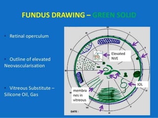 Elevated
NVE
membra
nes in
vitreous
IOL
 