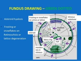 asteroid
Frosting or snowflakes
on schisis or lattice
membra
nes in
vitreous
Elevated
NVE
FVP
Weiss ring
Vitreous
substitute
 