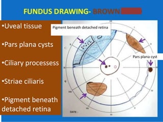 •Uveal tissue
•Pars plana cysts
•Ciliary processess
•Striae ciliaris
•Pigment beneath
detached retina
Pars plana cyst
Pigment beneath detached retina
 