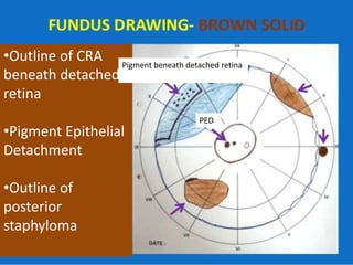 •Outline of CRA
beneath detached
retina
•Pigment Epithelial
Detachment
•Outline of
posterior
staphyloma
PED
Pigment beneath detached retina
 