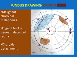 •Malignant
choroidal
melanomas
•Edge of buckle
beneath detached
retina
•Choroidal
detachment
CD
 