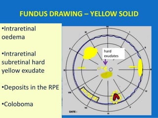 •Intraretinal
oedema
•Intraretinal
subretinal hard
yellow exudate
•Deposits in the RPE
•Coloboma
hard
exudates
 