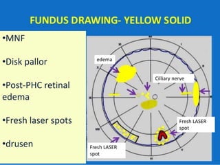 •MNF
•Disk pallor
•Post-PHC retinal
edema
•Fresh laser spots
•drusen
edema
Cilliary nerve
Fresh LASER
spot
Fresh LASER
spot
 