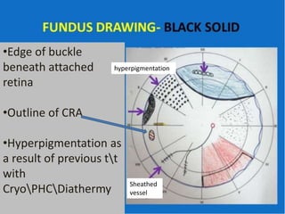 •Edge of buckle
beneath attached
retina
•Outline of CRA
•Hyperpigmentation as
a result of previous tt
with
CryoPHCDiathermy
hyperpigmentation
Sheathed
vessel
 
