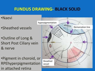 •Naevi
•Sheathed vessels
•Outline of Long &
Short Post Ciliary vein
& nerve
•Pigment in choroid, or
RPEhyperpigmentation
in attached retina
Sheathed
vessel
hyperpigmentation
Demarcation line
 