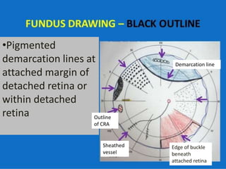 •Pigmented
demarcation lines at
attached margin of
detached retina or
within detached
retina
Edge of buckle
beneath
attached retina
Demarcation line
Sheathed
vessel
Outline
of CRA
 