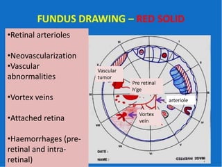 •Retinal arterioles
•Neovascularization
•Vascular
abnormalities
•Vortex veins
•Attached retina
•Haemorrhages (pre-
retinal and intra-
retinal)
Vascular
tumor
Vortex
vein
Pre retinal
h’ge
arteriole
 