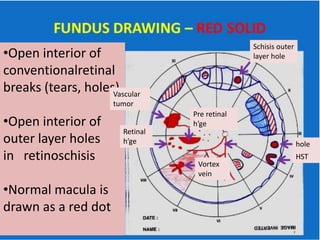 •Open interior of
conventionalretinal
breaks (tears, holes)
•Open interior of
outer layer holes
in retinoschisis
•Normal macula is
drawn as a red dot
Schisis outer
layer hole
hole
HST
Pre retinal
h’ge
Retinal
h’ge
Vortex
vein
Vascular
tumor
 