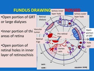 •Open portion of GRT
or large dialyses
•Inner portion of thin
areas of retina
•Open portion of
retinal holes in inner
layer of retinoschisis
Schisis outer
layer hole
HST
hole
Vortex
vein
Pre retinal
h’ge
Retinal
h’ge
Vascular
tumor
Retinal
dialysis
Schisis inner
layer hole
Open
portion
of GRT
 