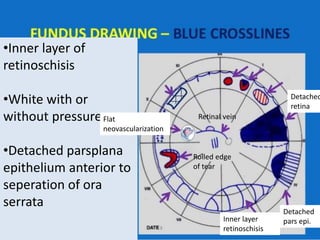 •Inner layer of
retinoschisis
•White with or
without pressure
•Detached parsplana
epithelium anterior to
seperation of ora
serrata
Inner layer
retinoschisis
Detached
pars epi.
Rolled edge
of tear
Flat
neovascularization
Retinal vein
Detached
retina
 