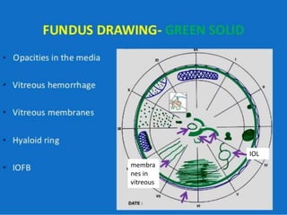 IOL
membra
nes in
vitreous
 
