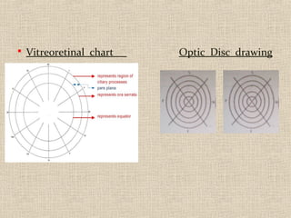  Vitreoretinal chart Optic Disc drawing
 