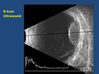 B-Scan
Ultrasound
 