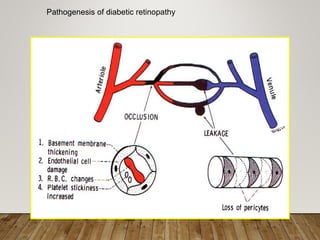 Pathogenesis of diabetic retinopathy
 