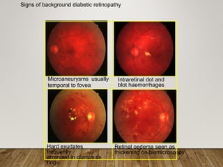 Signs of background diabetic retinopathy
Microaneurysms usually
temporal to fovea
Intraretinal dot and
blot haemorrhages
Hard exudates
frequently
arranged in clumps or
rings
Retinal oedema seen as
thickening on biomicroscopy
 