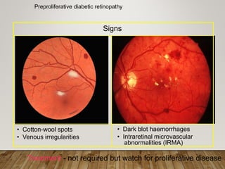 Preproliferative diabetic retinopathy
Treatment - not required but watch for proliferative disease
• Cotton-wool spots
• Venous irregularities
• Dark blot haemorrhages
• Intraretinal microvascular
abnormalities (IRMA)
Signs
 