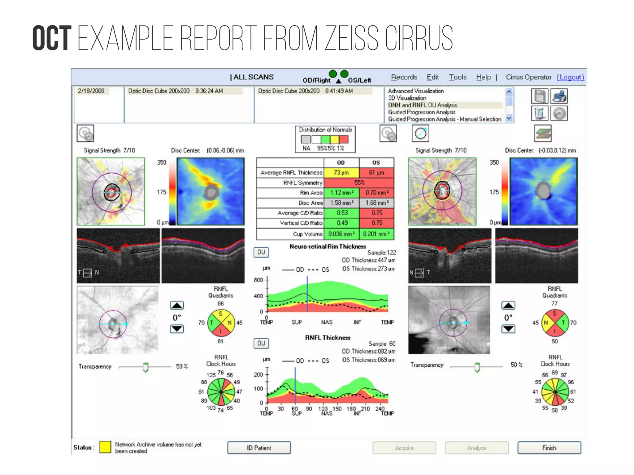 OCT Example report from Zeiss Cirrus
 