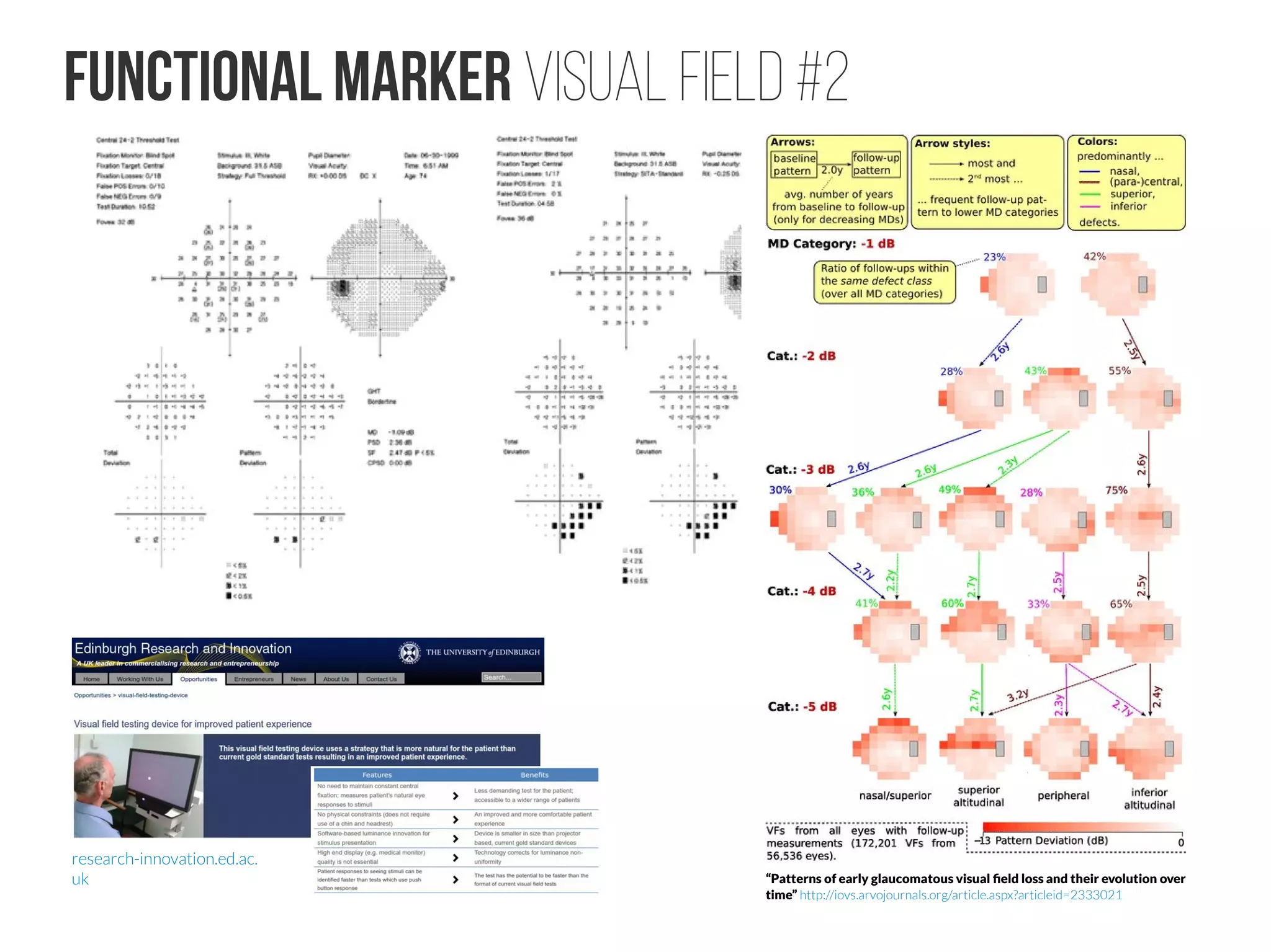 Functional marker VISUAL FIELD #2
“Patterns of early glaucomatous visual field loss and their evolution over
time” http://iovs.arvojournals.org/article.aspx?articleid=2333021
research-innovation.ed.ac.
uk
 