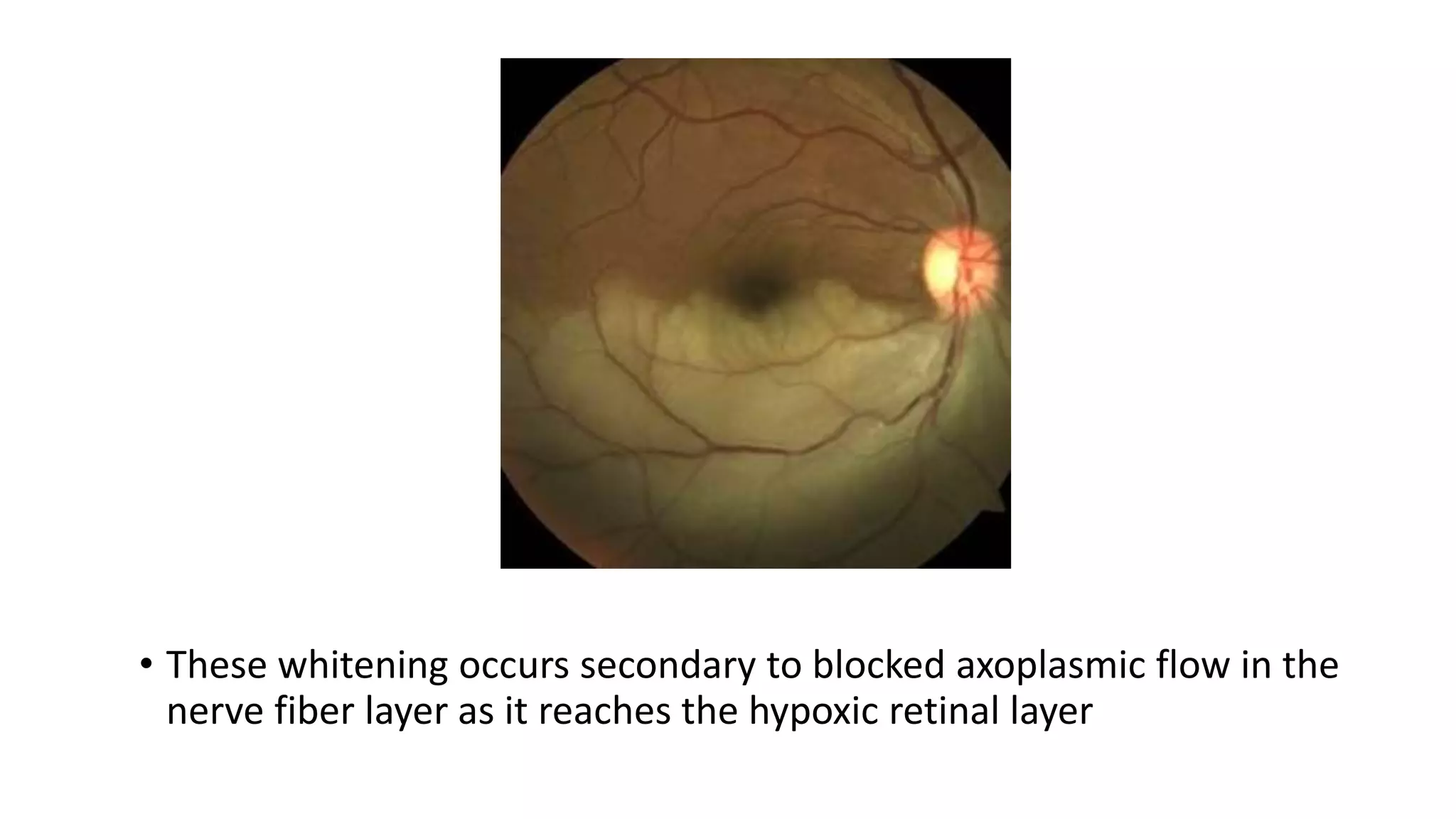 • These whitening occurs secondary to blocked axoplasmic flow in the
nerve fiber layer as it reaches the hypoxic retinal layer
 
