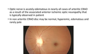 • Optic nerve is acutely edematous in nearly all cases of arteritic CRAO
as a result of the associated anterior ischemic optic neuropathy that
is typically observed in patient
• In non arteritic CRAO disc may be normal, hyperemic, edematous and
rarely pale
 