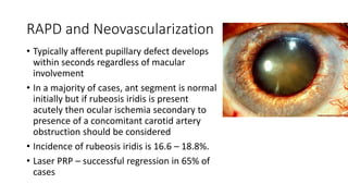 RAPD and Neovascularization
• Typically afferent pupillary defect develops
within seconds regardless of macular
involvement
• In a majority of cases, ant segment is normal
initially but if rubeosis iridis is present
acutely then ocular ischemia secondary to
presence of a concomitant carotid artery
obstruction should be considered
• Incidence of rubeosis iridis is 16.6 – 18.8%.
• Laser PRP – successful regression in 65% of
cases
 