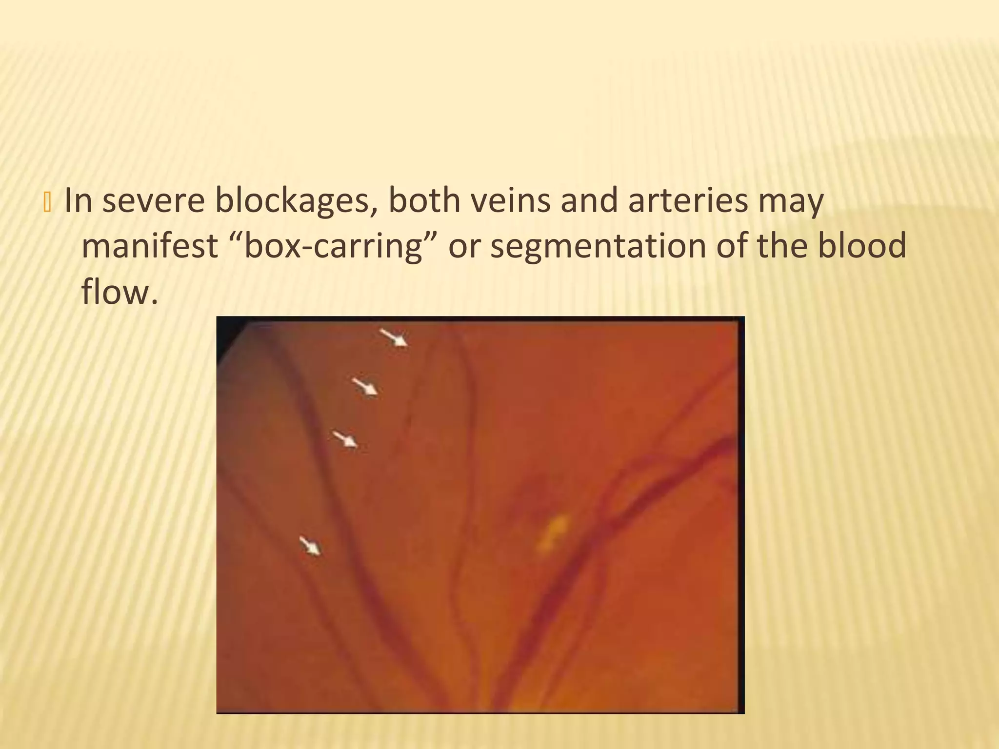 � In severe blockages, both veins and arteries may
manifest “box-carring” or segmentation of the blood
flow.
 