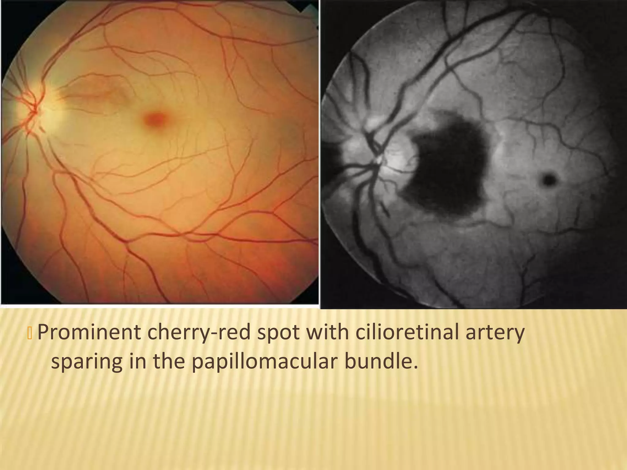 � Prominent cherry-red spot with cilioretinal artery
sparing in the papillomacular bundle.
 