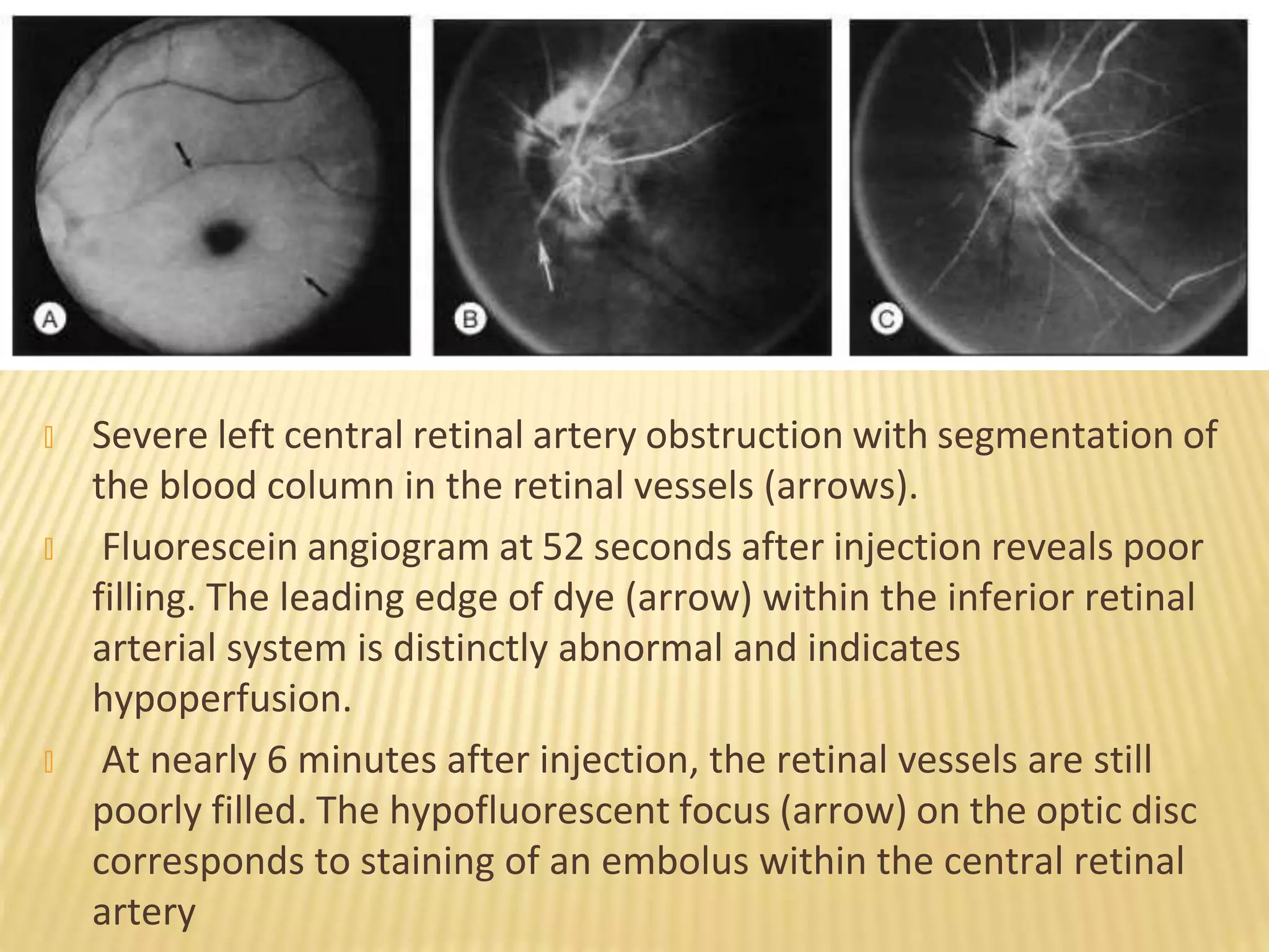 � Severe left central retinal artery obstruction with segmentation of
the blood column in the retinal vessels (arrows).
� Fluorescein angiogram at 52 seconds after injection reveals poor
filling. The leading edge of dye (arrow) within the inferior retinal
arterial system is distinctly abnormal and indicates
hypoperfusion.
� At nearly 6 minutes after injection, the retinal vessels are still
poorly filled. The hypofluorescent focus (arrow) on the optic disc
corresponds to staining of an embolus within the central retinal
artery
 