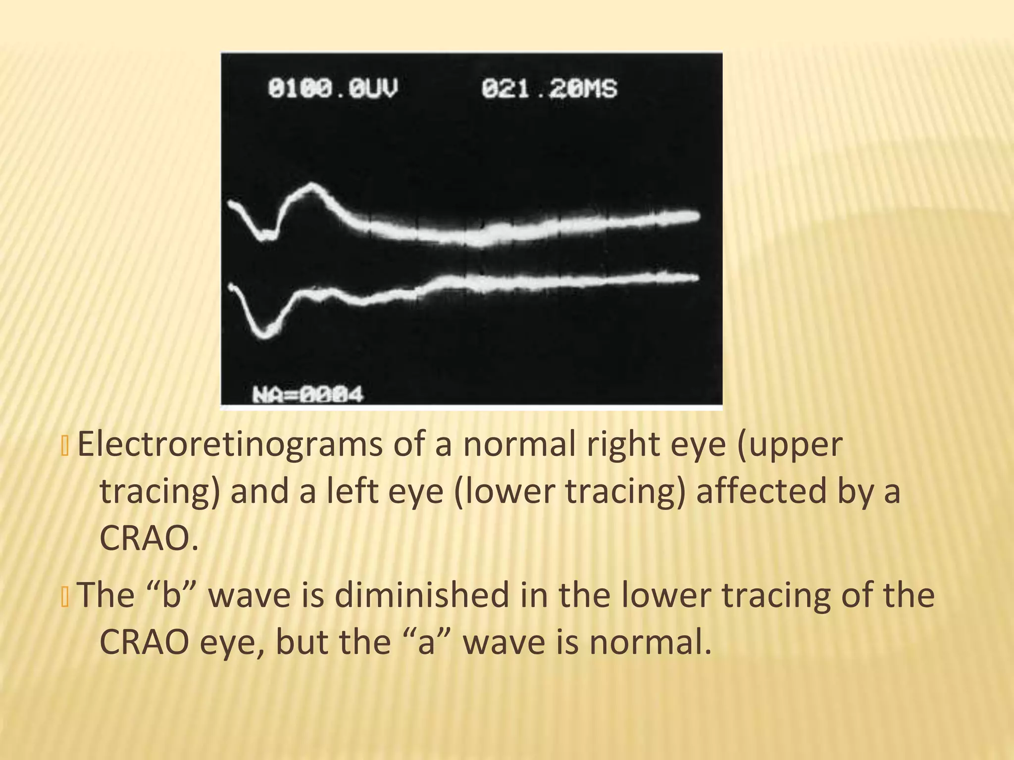 � Electroretinograms of a normal right eye (upper
tracing) and a left eye (lower tracing) affected by a
CRAO.
� The “b” wave is diminished in the lower tracing of the
CRAO eye, but the “a” wave is normal.
 