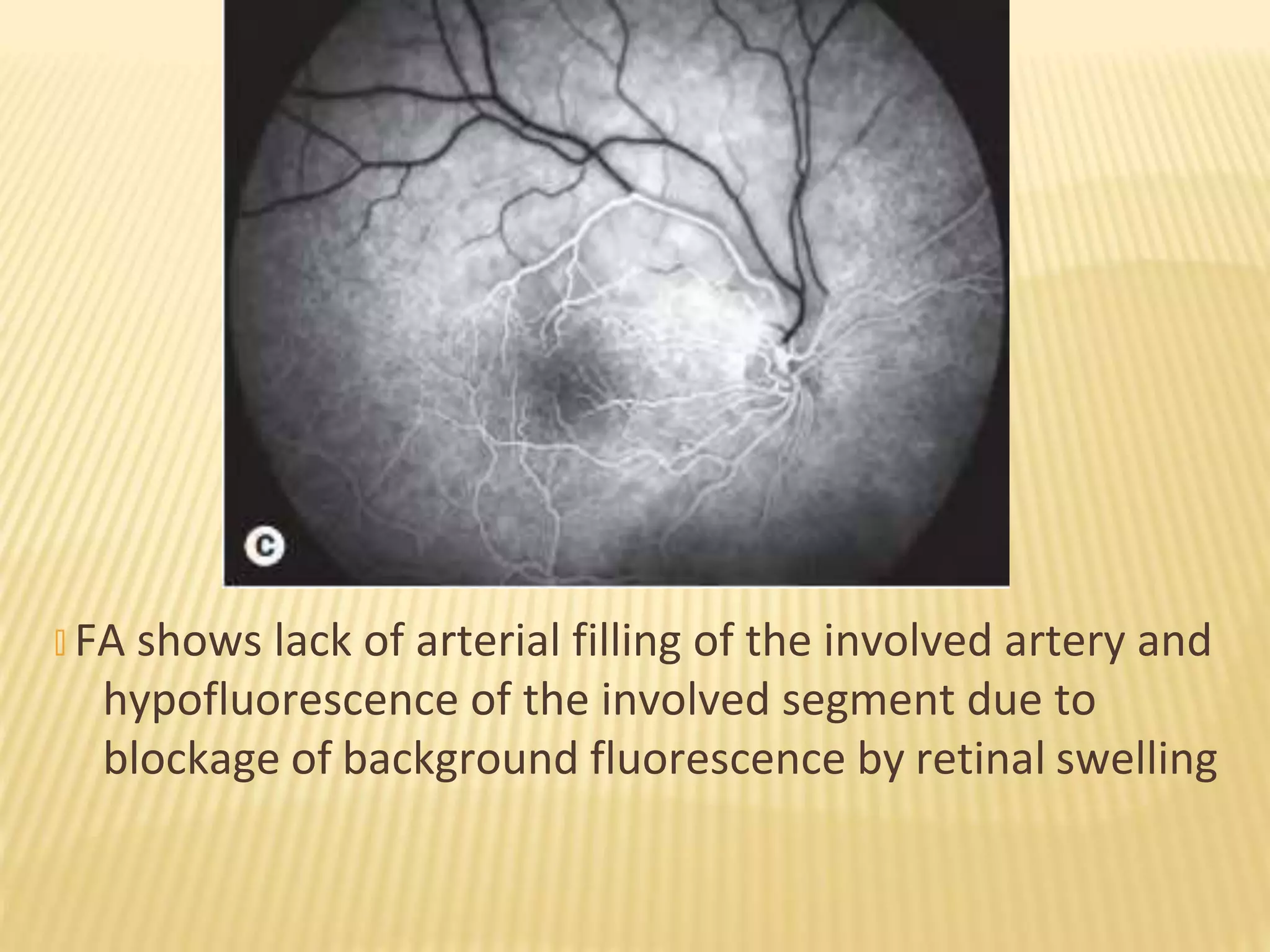 � FA shows lack of arterial filling of the involved artery and
hypofluorescence of the involved segment due to
blockage of background fluorescence by retinal swelling
 