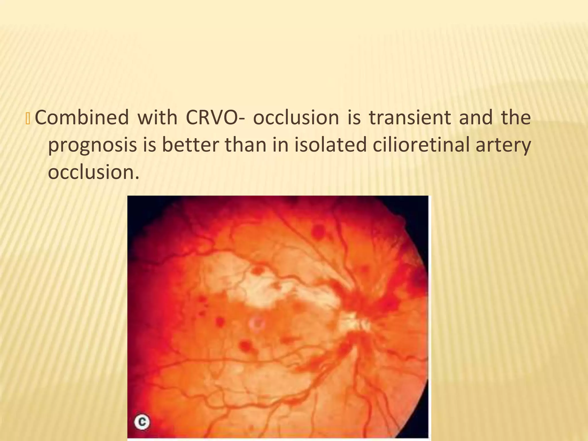 � Combined with CRVO- occlusion is transient and the
prognosis is better than in isolated cilioretinal artery
occlusion.
 