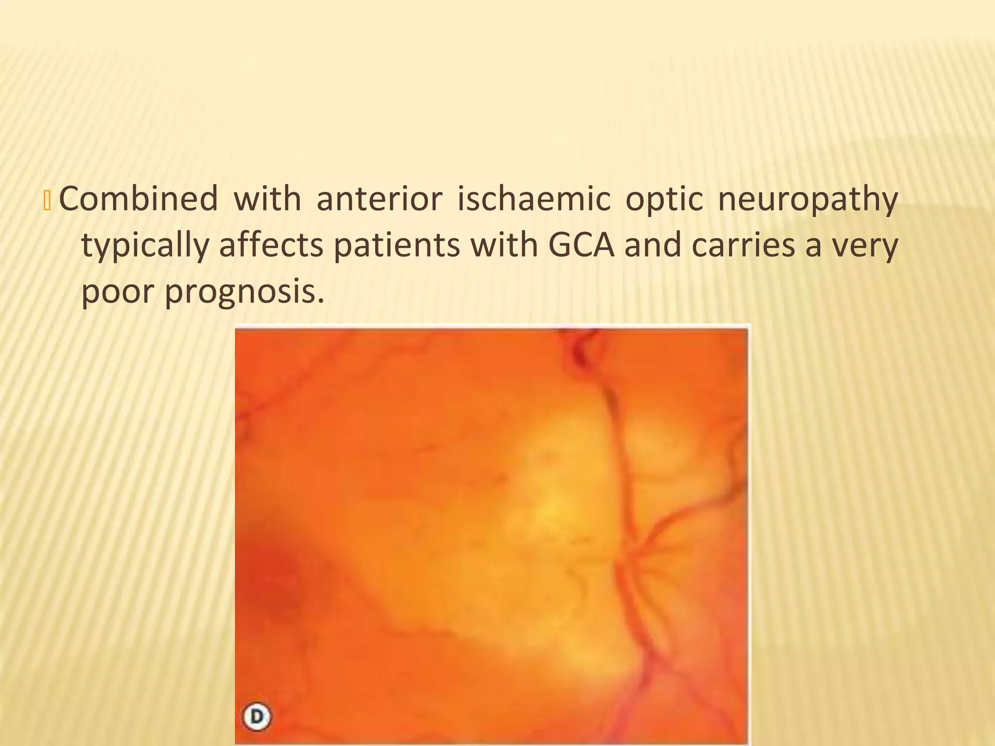 � Combined with anterior ischaemic optic neuropathy
typically affects patients with GCA and carries a very
poor prognosis.
 