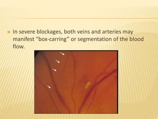 Retinal artery occlusions | PPTX