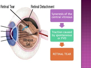 Operculated Break Retinal breaks | PPT