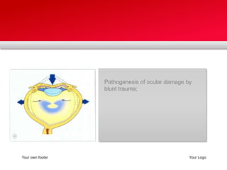 Your own footerYour LogoPathogenesis of ocular damage by blunt trauma;
